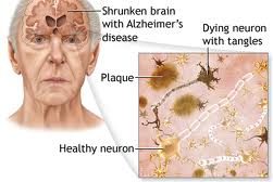 Penyakit Alzheimer: Pengertian, Penyebab, dan Gejala