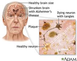 penyakit alzheimer