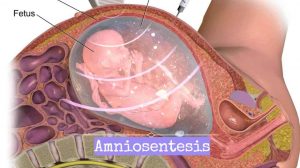 Amniosentesis: Diagnosa Kelainan dan Gangguan Kesehatan Janin Dalam Kandungan