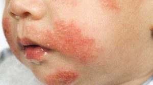 Jenis, Penyebab dan Gejala Alergi Pada Anak