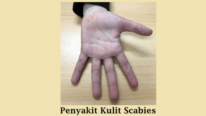 Penyakit Kulit Scabies