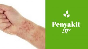 Penyakit ITP: Gejala, Penyebab, Diagnosis, dan Pengobatan