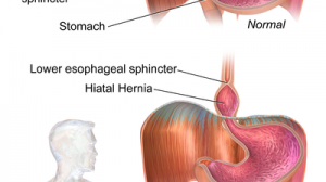 Apakah Penyakit Hernia?