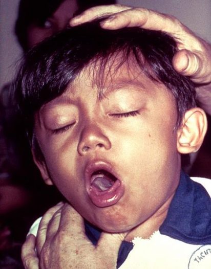 Anak rentan terkena TB