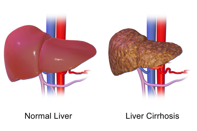 Cara mencegah penyakit liver