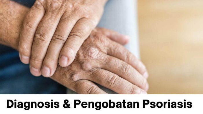 Diagnosis - Pengobatan Psoriasis